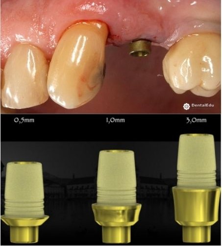 DESS® C-Base clinical case DESS® C-Base clinical case